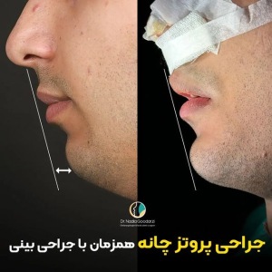 genioplasty-01