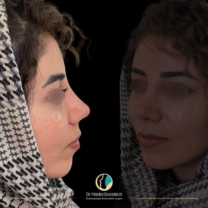 جراحی-بینی-05