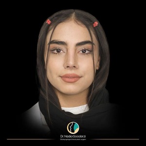 جراحی-بینی-06