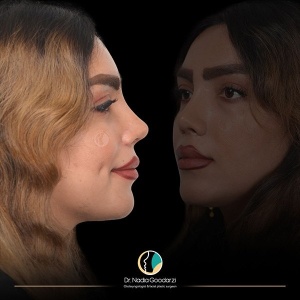 جراحی-بینی-07