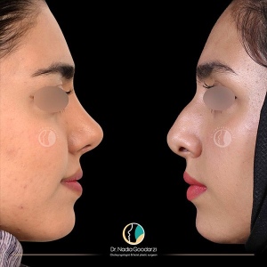 جراحی-بینی-09