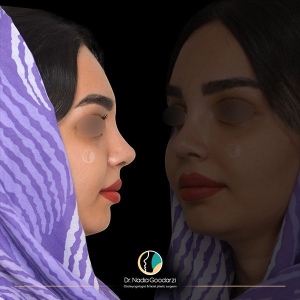 جراحی-بینی-10