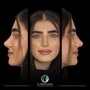جراحی-بینی-11