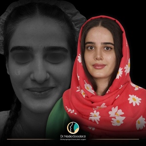 جراحی-بینی-13