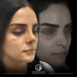 جراحی-بینی-16