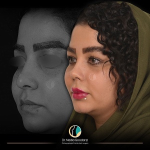 جراحی-بینی-19