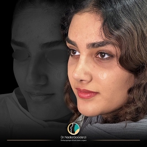 جراحی-بینی-22