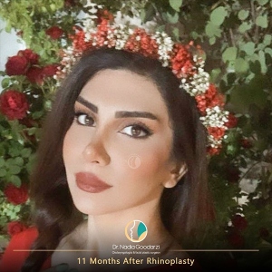 جراحی-بینی-28