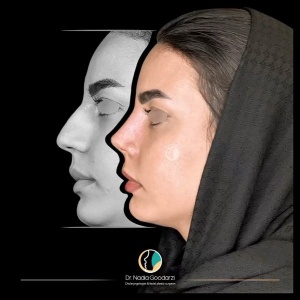 جراحی-بینی-32