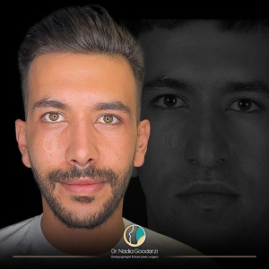 جراحی-بینی-34