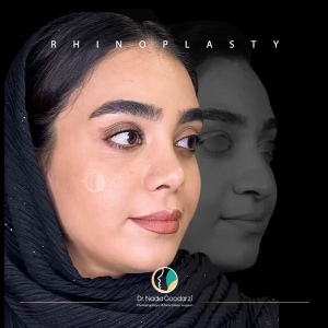 جراحی-بینی-36