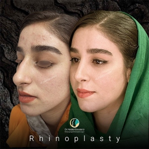 جراحی-بینی-45