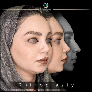جراحی-بینی-46
