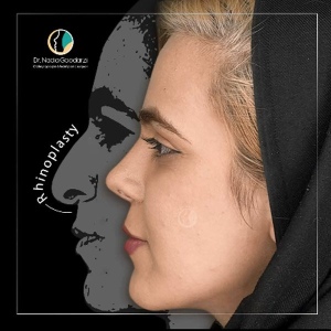 جراحی-بینی-56