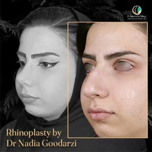 جراحی-بینی-58