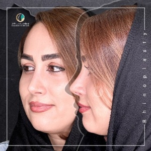 جراحی-بینی-67
