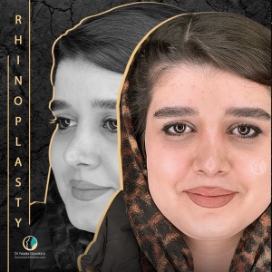 جراحی-بینی-72