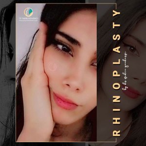 جراحی-بینی-73