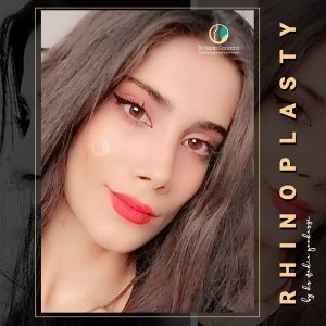 جراحی-بینی-75