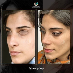 جراحی-بینی-76