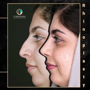 جراحی-بینی-79