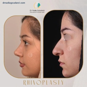 rhinoplasty-100
