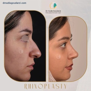 rhinoplasty-101