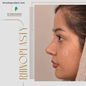 rhinoplasty-102
