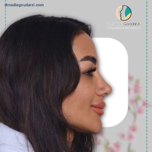 rhinoplasty-103