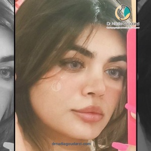 rhinoplasty-104