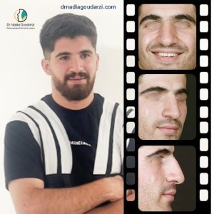 rhinoplasty-105