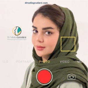 rhinoplasty-106