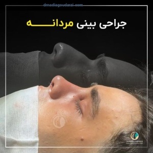 rhinoplasty-107
