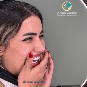 rhinoplasty-108