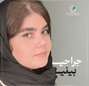 rhinoplasty-109