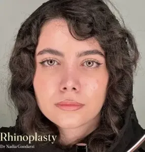 rhinoplasty-110