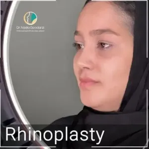 rhinoplasty-111