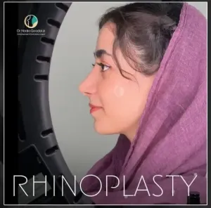 rhinoplasty-112