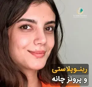 rhinoplasty-113