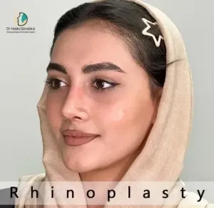rhinoplasty-114