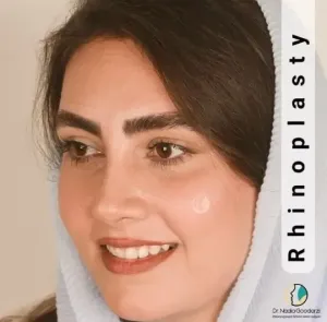 rhinoplasty-115