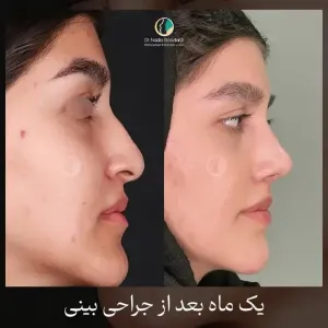 rhinoplasty-116