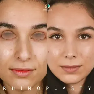 rhinoplasty-117