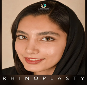 rhinoplasty-120