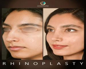 rhinoplasty-121