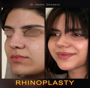 rhinoplasty-123