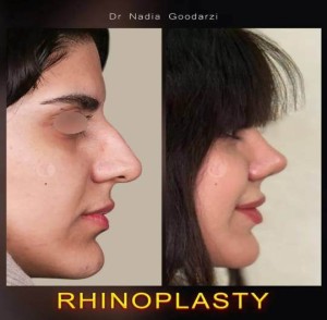 rhinoplasty-124