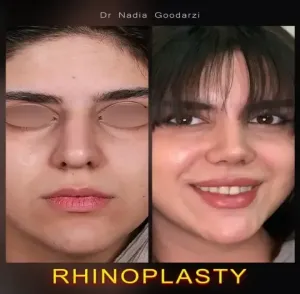 rhinoplasty-125