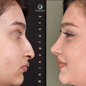 rhinoplasty-81