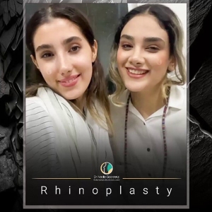 rhinoplasty-82
